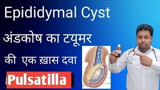 Epididymal cyst homeopathic medicine Pulsatilla for Epididymal cyst in hindi [upl. by Yelhak]