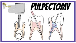 PULPECTOMY  Indications Contraindications Rationale obturation materials [upl. by Agnese]