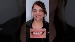 smile smilemakeoverturkey cosmeticsurgery beforeandafter dentalcosmeticturkey smilemakeover [upl. by Bertold304]