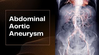 Abdominal Aortic Aneurysm [upl. by Holly-Anne]