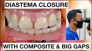 Step by Step Diastema Closure Composite with Big Gaps  General Dentist Griya RR [upl. by Ahsilrak]