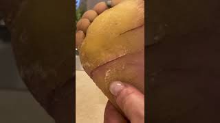 Fissure crack maintenance  Keratoderma Callus EPPK Hyperkeratosis  May 8 2023 [upl. by Stefa970]