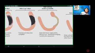 Clase 12  Cardiopatía Isquémica en el ECG  Diplomado de Electrocardiografía [upl. by Sclar]