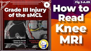 Fig 3A09 Grade III Injury of the sMCL and Medial Patellofemoral Ligament Injuries [upl. by Arimat]