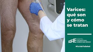 Varices qué son por qué aparecen y cómo se tratan  CuidaTuSalud Clínico San Cecilio [upl. by Direj]