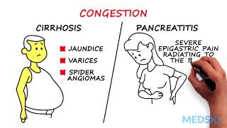 Splenomegaly Remember the 3 primary causes with CIP [upl. by Yvon]