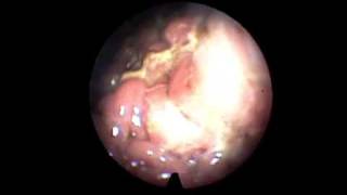 TransNasal Esophagoscopy TNE Esophageal Candidiasis [upl. by Nnaeirual544]