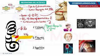 Otorrinolaringología  Neurinoma del acustico [upl. by Ekenna532]