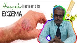 Eczema Dermatitis Treatment in Homeopathy by Dr PS Tiwari [upl. by Navis530]