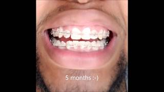 Braces 6 Month Timelapse [upl. by Rodie]