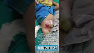 Ileostomy  indication where it is donesurgery [upl. by Drandell229]