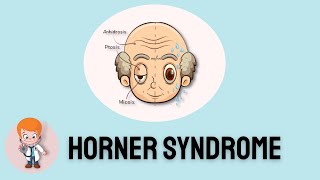 Horner Syndrome Signs and symptoms and insights [upl. by Genet]