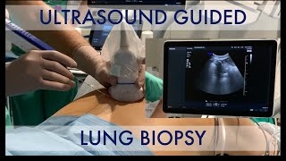 USguided lung biopsy [upl. by Noemi797]