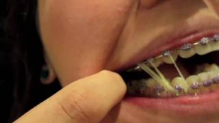 Braces Update  12 double elastics [upl. by Stirling]