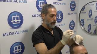 ¿Cómo se aplica el minoxidil Detener la caída del pelo [upl. by Caves]