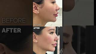 Jaw enhancement with filler with Jonathon [upl. by Kesia494]