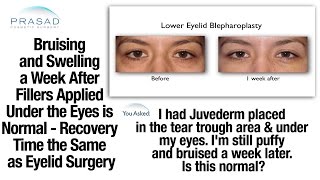 Swelling and Bruising after Cosmetic Filler Application is Part of the Normal Healing Process [upl. by Cassi]