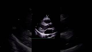 What is Attenuation echocardiography [upl. by Orlanta]