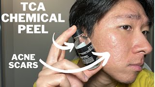 How to get rid of acne scars with micro needling and TCA chemical peel [upl. by Mello]