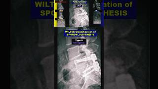 Spondylolisthesis  Wiltse Classification radiology bones spine xray [upl. by Miles]