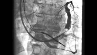 Coronary sinus venogram [upl. by Notlaw868]