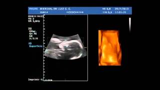 Ecografia obstétrica 27 semanas de gestação [upl. by Grange]