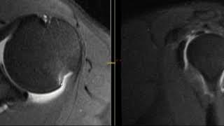 Bankarts and Hill Sachs lesion MRI shoulder in recurrent anterior dislocation [upl. by Radbourne]