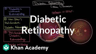 Diabetic retinopathy  Endocrine system diseases  NCLEXRN  Khan Academy [upl. by Wohlert]