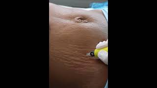 Stretch Marks Inkless Removal Boleyn Treatment Los Angeles 🌍 shorts [upl. by Enar]