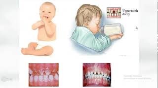 lecture 3 Dental caries with Dr omnya wahba clinical aspects  Classification of dental caries [upl. by Arleta]