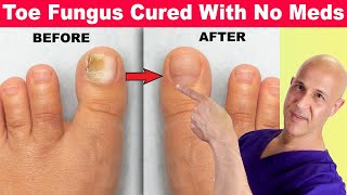 Toe Nail Fungus Cured With No Meds Dr Mandell [upl. by Lamori]