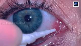 Mucus fishing Syndrome explained indetail eyecareoptom5506 optometry eye eyelid optometrist [upl. by Adner406]