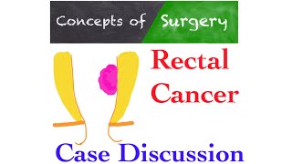 Rectal cancer case discussion and management algorithm [upl. by Prior]