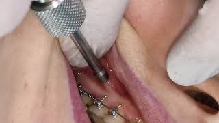 Mini screw mini implant insertion  screwing in orthodontic miniimplant TAD [upl. by Erminia]