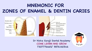 MNEMONIC FOR ZONES OF ENAMEL AND DENTIN CARIES  DR NISHA GARGS DENTAL ACADEMY  NEET 2022 [upl. by Kcirddec]