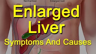 Enlarged Liver Symptoms And Causes  What Is Hepatomegaly [upl. by Brine]