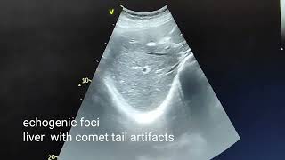 Pneumobilia due to gallbladder calculus ultrasound and color Doppler video [upl. by Aronoel170]