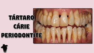 DESCUBRA o Que Acontece Se Você NÃO Escovar os Dentes  Cárie e Periodontite [upl. by Darlleen831]