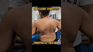 Ankylosing Spondylitis chiropractic treatment chiropractic chiropractor [upl. by Cassil]