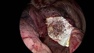 Thoracoscopic biopsy of lung cancer [upl. by Einnaf]