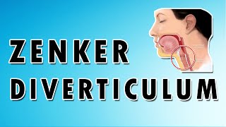 Zenkers Diverticulum [upl. by Yorgen]