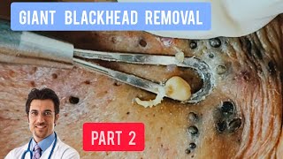 Massive blackhead removal inside a dermatology clinic  DrAMAZINGSKIN [upl. by Jehiel]