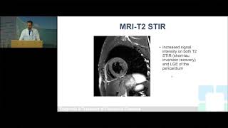 Pericardial Cases Does Pericarditis Ever Get Better [upl. by Kayle]