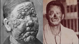 The TERRIFIC History of Leprosy [upl. by Dralliw]