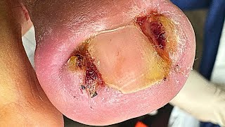 Extreme Double Ingrown Toenail Removal  Satisfying Fix [upl. by Renelle]