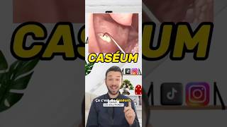 Qu’est ce que le Caséum  tonsil tonsilstones tonsilitis caseum breath breathing santé [upl. by Redan]