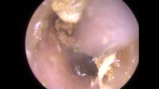 178 Removal of Ear Wax reveals Signs of Otomycosis  Mr Neel Raithatha The Hear Clinic [upl. by Anelet]