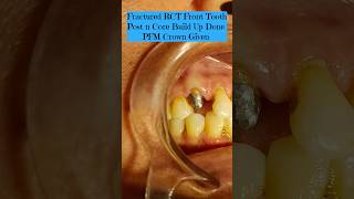 Fractured Tooth Replacement smile youtubeshorts dentist viralvideo beautiful [upl. by Adnirual]