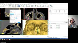 Materialise Mimics Quickstart Segmentation Skull [upl. by Zippel]