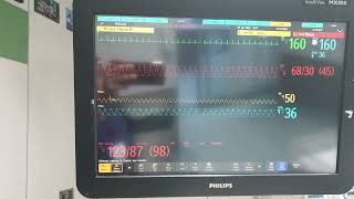 Fluke Prosim 8 Philips MX800 amp X3 with Neonatal Manikin [upl. by Eyahs]